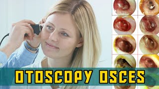 OTOSCOPY OSCEs  PLAB Image Reference [upl. by Eniawd]