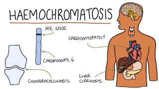 Understanding Haemochromatosis [upl. by Nader543]