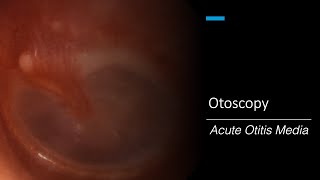 Acute Otitis Media Otoscopy [upl. by Fevre]