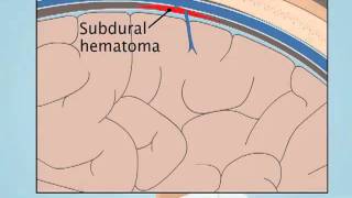 Understanding Subdural Hematoma [upl. by Illona]