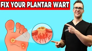 Plantar Warts Removal at Home Treatment Foot amp Toe Wart Remedies [upl. by Sherwynd767]