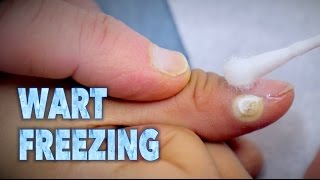 FREEZING WARTS With Sizzling Liquid Nitrogen  Dr Paul [upl. by Noid]