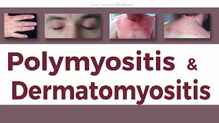 A Simplified Overview of Polymyositis amp Dermatomyositis  Clinical Features Diagnosis amp Treatment [upl. by Eisler842]