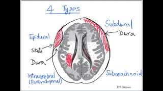 Intracranial Bleed  Part 1 [upl. by Jessie339]