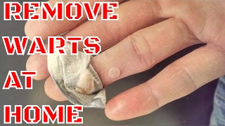 WART REMOVAL  HOW TO REMOVE WARTS AT HOME [upl. by Evelyn]