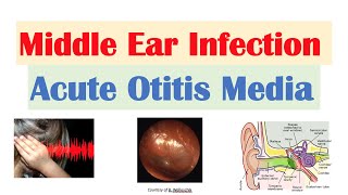 Middle Ear Infection Acute Otitis Media  Causes Symptoms Diagnosis Treatment [upl. by Fiona265]