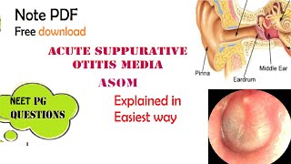 Acute Suppurative Otitis Media  ASOM  ENT  Easy explanation  Stages  Diagnosis  Management [upl. by Evelunn]