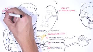 Acute Otitis Media Causes Pathophysiology signs and symptoms treatment and complications [upl. by Aiynat617]