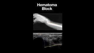 Ultrasound Guidance In Hematoma Block [upl. by Kamat866]