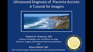 Prenatal Ultrasound Diagnosis of Placenta Accreta 2015 [upl. by Xela]