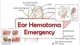 Ear Hematoma Emergency [upl. by Hendon]