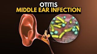 Middle Ear Infection Otitis Media Causes SIgns and Symptoms Diagnosis and Treatment [upl. by Euridice538]