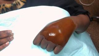 hand hematoma drainage [upl. by Annatnom]