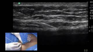 The UltrasoundGuided Rectus Sheath Block RSB [upl. by Suaeddaht720]