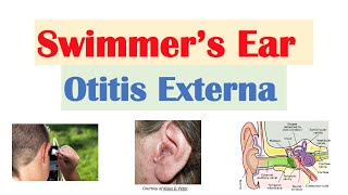 Swimmer’s Ear Otitis Externa  Risk Factors Causes Signs amp Symptoms Diagnosis Treatment [upl. by Karola568]