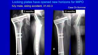 Complex Proximal Femur Fractures [upl. by Nitsreik812]