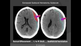 Subdural Hematoma SDH [upl. by Yvaht]