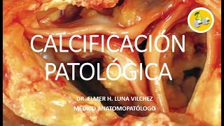 CALCIFICACIÓN PATOLÓGICA  Dr Elmer Luna Vilchez [upl. by Eirual415]