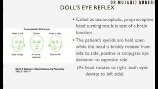 Testing the Red Eye Reflex [upl. by Aicener]