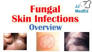 Overview of Fungal Skin Infections  Tinea Infections [upl. by Aharon674]