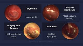 Acute Otitis Media Otoscopic Findings [upl. by Martin746]