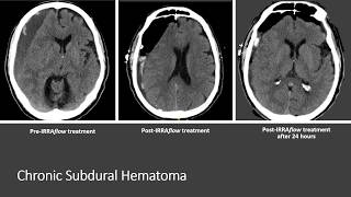 Novel Treatment Protocol for Chronic Subdural Hematomas [upl. by Lonnard888]